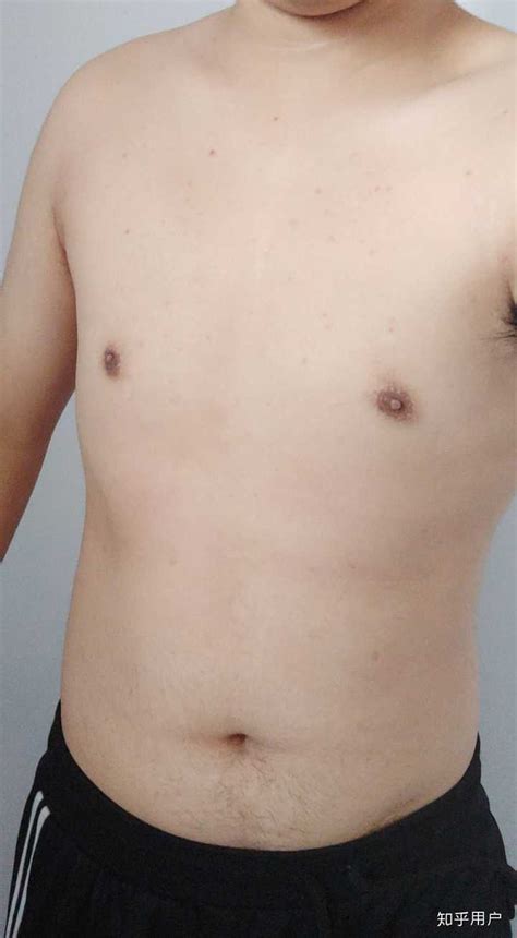 男人胸|男性乳房增大（男性乳房发育症）